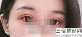 绵阳割双眼皮哪专业,2022绵阳割双眼皮专家医院排名实力超强