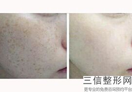 面部热玛吉除皱哪家医院好,2022四川西婵整形美容医院口碑良好