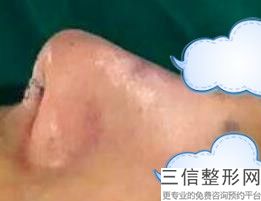 南昌正规隆鼻医院排名公布,2022南宁艺职美整形排名靠前