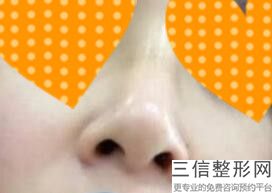 南昌做隆鼻整形医院排行榜六强预览,2022南昌大学医疗美容医院不容错过