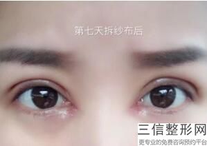 南昌做双眼皮修复医生排名榜出炉,2022涂飞翔医生遥遥领先