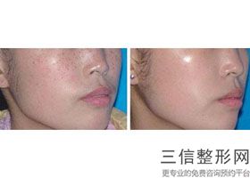 南充热玛吉官方授权医院有哪些,2022南充阿蓝整形医院实力入围