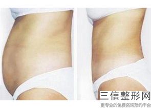 南京大腿吸脂医院排名前十,2022南京华美美容医院实力非凡