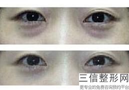 南京割双眼皮排名,2022 南京市第一医院整形外科实力入围