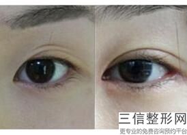 南京割双眼皮医生排名榜前五口碑公布,2022袁斯明口碑良好