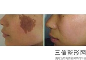 南京拉皮手术比较好的医院排行榜前四,2022南京康美整形医院实力入围