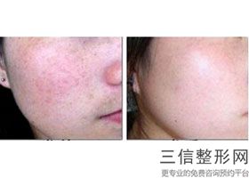 南京拉皮手术哪个医生做得好,2022林金德医生口碑良好
