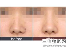南京隆鼻医生排名前十全新来袭,2022郭文煜实力超强