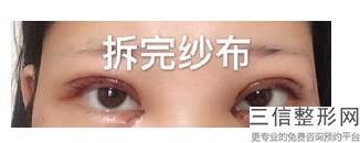 杭州双眼皮哪家做的好,2022杭州双眼皮整形医院排行榜不容错过