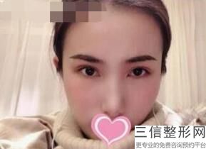 杭州双眼皮修复专家名单公开可查,2022刘中策位列前十