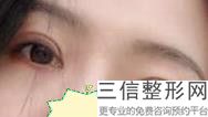 杭州双眼皮医生排名榜前三,2022杨连华实力入围