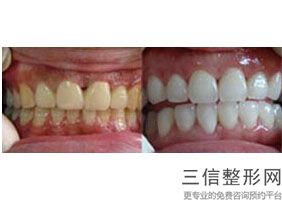 杭州牙齿整形医院排名前八口碑优选,2022杭州马泷口腔门诊部口碑不错