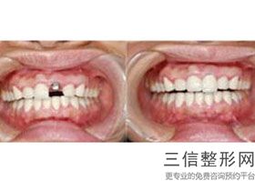 杭州种植牙医院排行榜前三揭晓,2022杭州美奥口腔门诊部遥遥领先