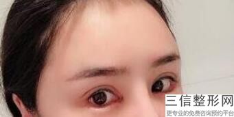 杭州做双眼皮的正规医院排名表公布,2022杭州菁肌医疗美容诊所遥遥领先
