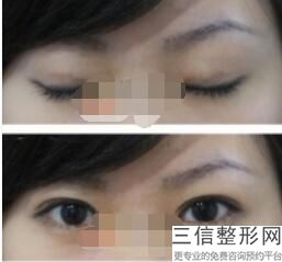 杭州做双眼皮医生排名榜十强推荐,2022朴洪全医生实力上榜
