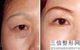 合肥割眼袋十大医院名单公示,2022合肥奥美医疗美容门诊部位列前十