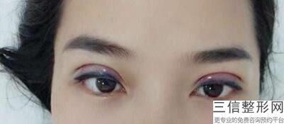 合肥排名第1的割双眼皮医院是哪家,2022合肥105整形美容医院遥遥领先