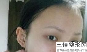 合肥双眼皮修复好的整形医院有哪些,2022合肥壹加壹整形医院排名靠前