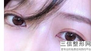 合肥双眼皮医院排名前十名单抢先知晓,2022合肥华美整形外科医院实力非凡