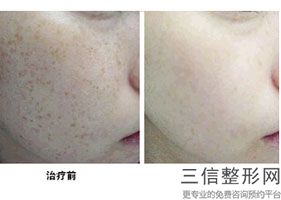 合肥做热玛吉的公立医院排行榜,2022安徽省第二人民医院整形科首次上榜