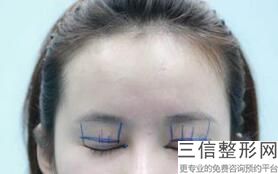 合肥做双眼皮好的整形医院推荐,2022合肥维多利亚整形医院实力入围