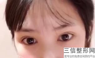 杭州双眼皮医生排名前十,2022高俊明医生位列前十