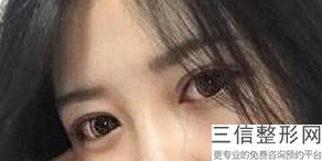 杭州双眼皮医院哪家好,2022浙医二院整形科实力超强