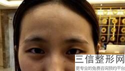 杭州双眼皮整形医院排行前五,2022杭州华山连天美整形医院锁定前十
