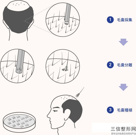 杭州植发医院排名前三的有哪些,2022杭州碧莲盛植发实力超强