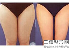 合肥丰胸医院名单,2022合肥维多利亚整形医院口碑不错