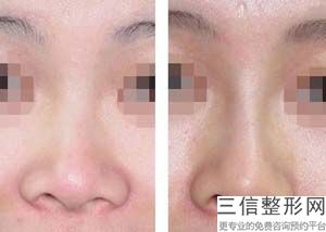 合肥隆鼻专家排名前三,2022合肥专家排名前三锁定前十