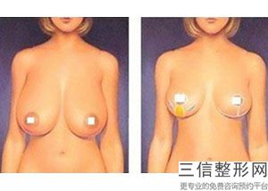 合肥隆胸整形医院排名前十跟踪发布,2022合肥福华整形医院不容错过