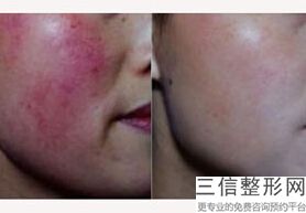合肥皮秒祛斑哪里好,2022合肥亚典医疗美容医院遥遥领先