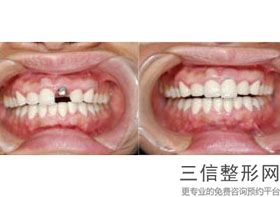 拔完牙是镶牙好还是种牙好，后牙拔了镶牙需要镶什么样的