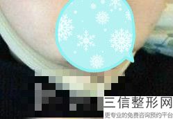 薄唇变厚的手术过程，厚唇改薄手术怎么做
