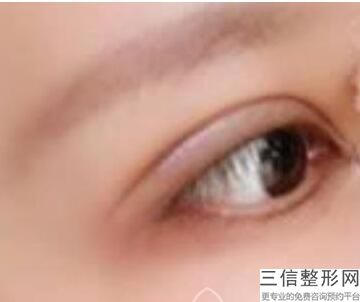 保定开眼角一般要多少钱，开眼角得多少钱