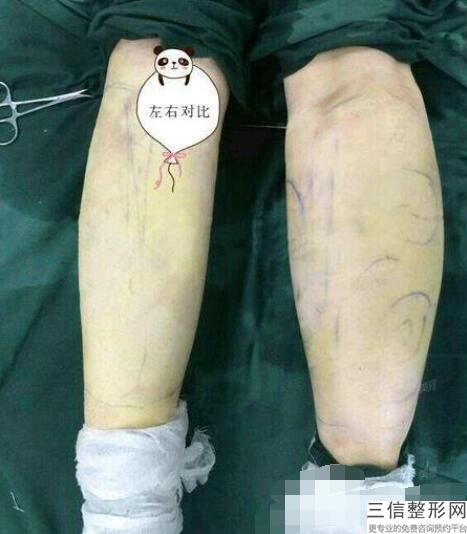 北京整形医院的丰胸价格，专业丰胸整形医院