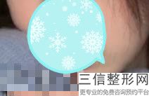 被厚唇变薄手术害惨了,厚唇变薄术图片