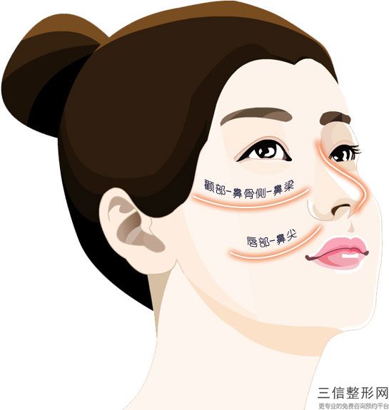 玻尿酸垫下巴有用吗，用玻尿酸垫下巴后悔了
