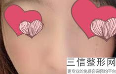 玻尿酸隆鼻的危害性有哪些，玻尿酸隆鼻好不好
