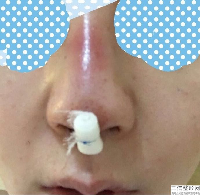 玻尿酸隆鼻和假体隆鼻的区别，假体隆鼻和玻尿酸隆鼻哪个更安全