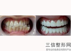 补牙是怎么补法,补牙两种方法