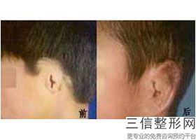 成都耳朵整形大概需要多少钱在赞扬民生耳鼻喉，成都哪家医院治耳朵比较好-