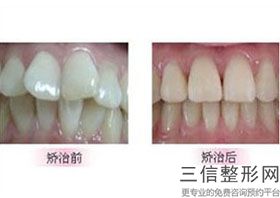 成人口呼吸会导致龅牙吗,口呼吸造成的嘴凸是骨性还是牙性