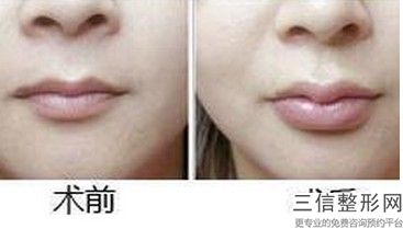 成人兔唇整形能整好么，兔唇医院良好的医院