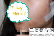成人兔唇整形能整好么，兔唇医院良好的医院