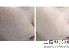 抽脂后皮肤皱怎么办，脸部抽脂后遗症