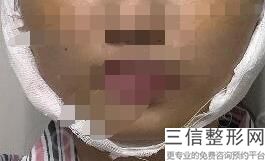 唇部脱毛激光和冰点区别，冰点激光脱唇毛会再出来吗