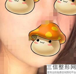 唇峰不明显可以整形吗，做唇峰多少钱