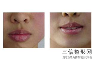 唇峰不明显可以整形吗，做唇峰多少钱